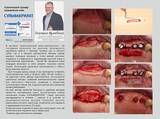 Применение "Сульфакрилата" в стоматологической трансплантологии.